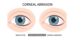 Corneal Damage