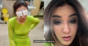 Corneal Damage